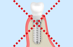 インプラント治療に適さないのはこんな人！