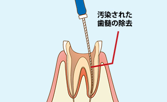 歯の神経にまで達してしまった歯