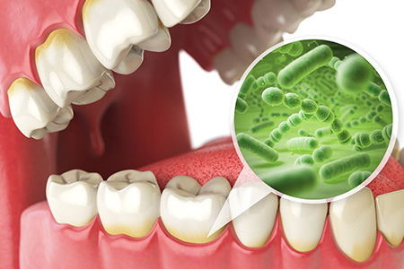 歯周病の細菌